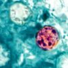 Two Michigan Residents Die Following Cyclosporiasis Infections Amid Nationwide Outbreak